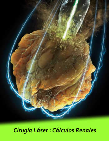 calculos renales quito