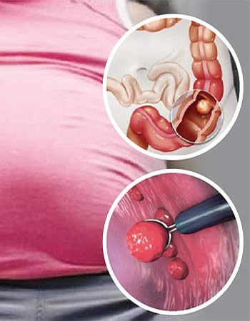 <cancer colon recto quitoL>