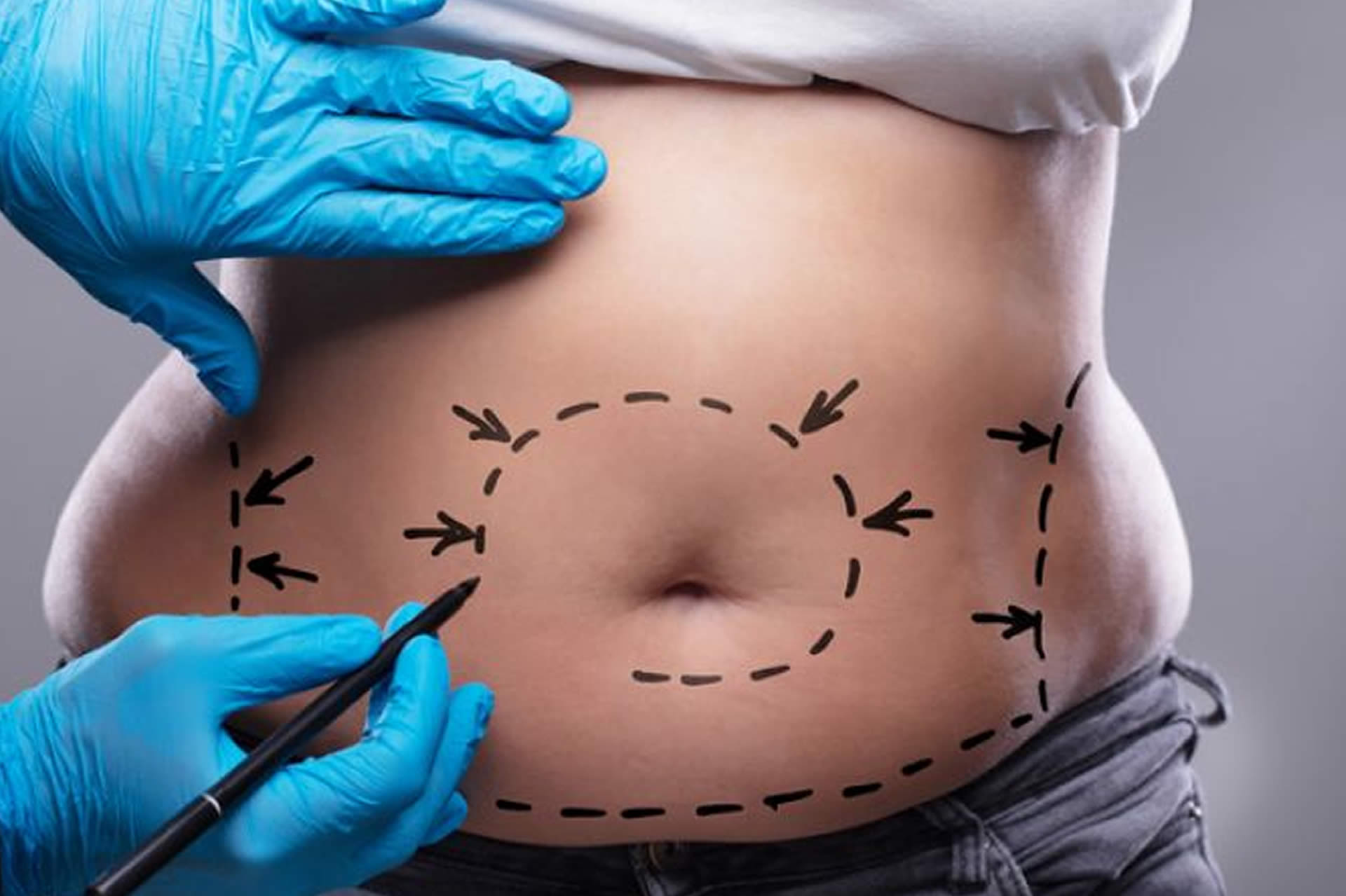 rinoplastia ultrasonica