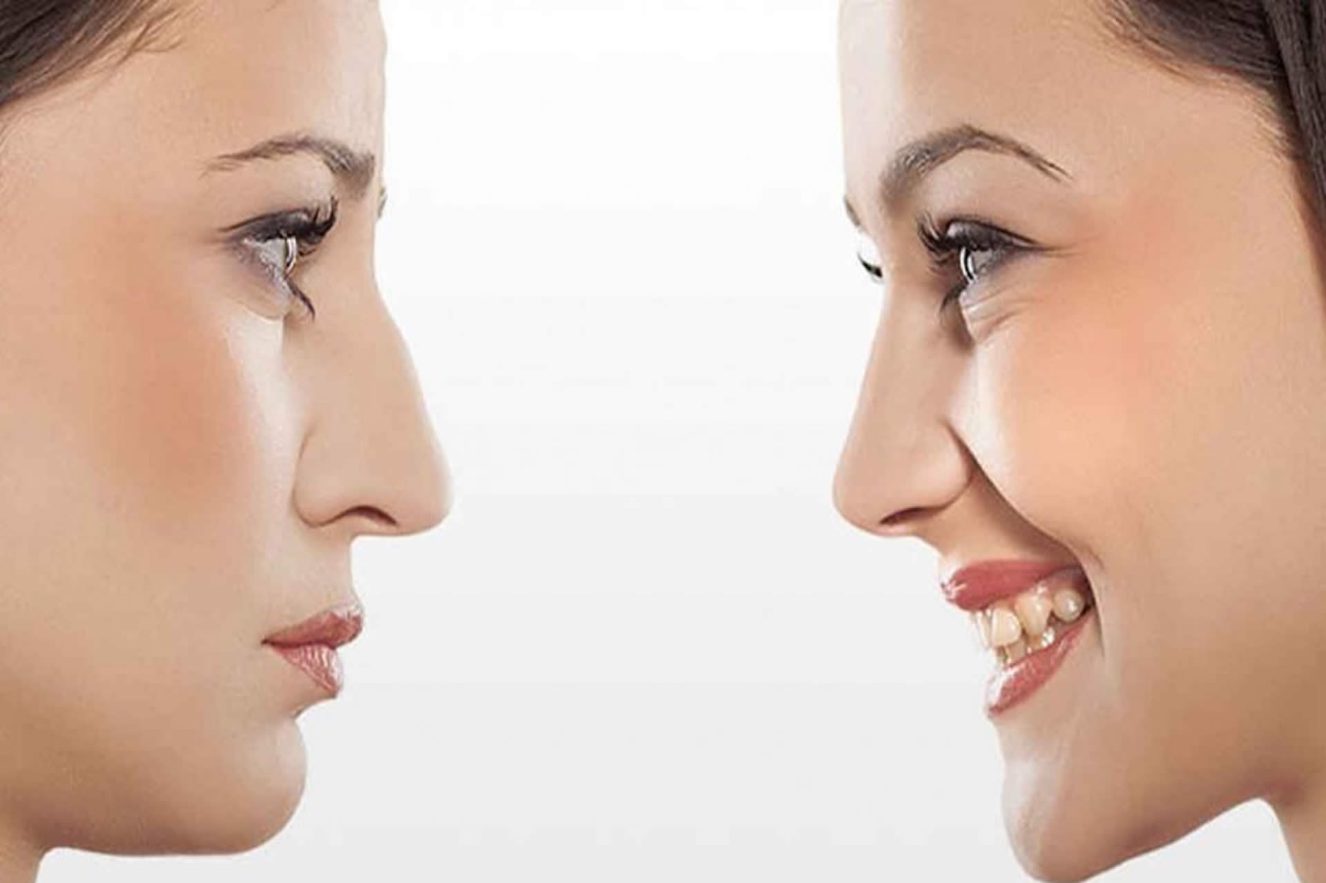 rinoplastia ultrasonica